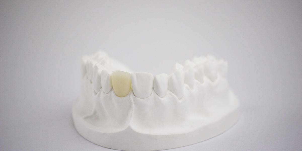 Zirconia Crown DDDL scaled